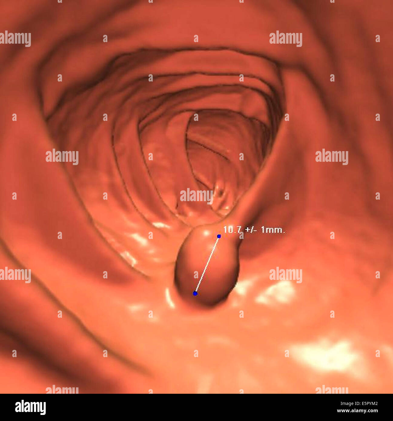 Sigmoid Colon Stock Photos & Sigmoid Colon Stock Images Alamy
