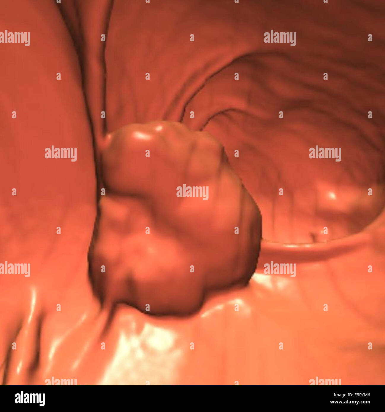 Ct Colon Poly A 3D computed tomography (CT) scan of the colon, showing a massive ...
