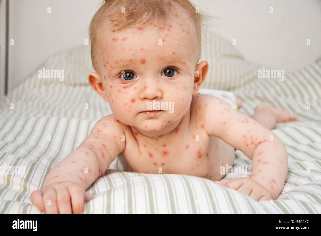 Chickenpox On A 4 Month Old Baby Chickenpox On A 4 Month Old Baby