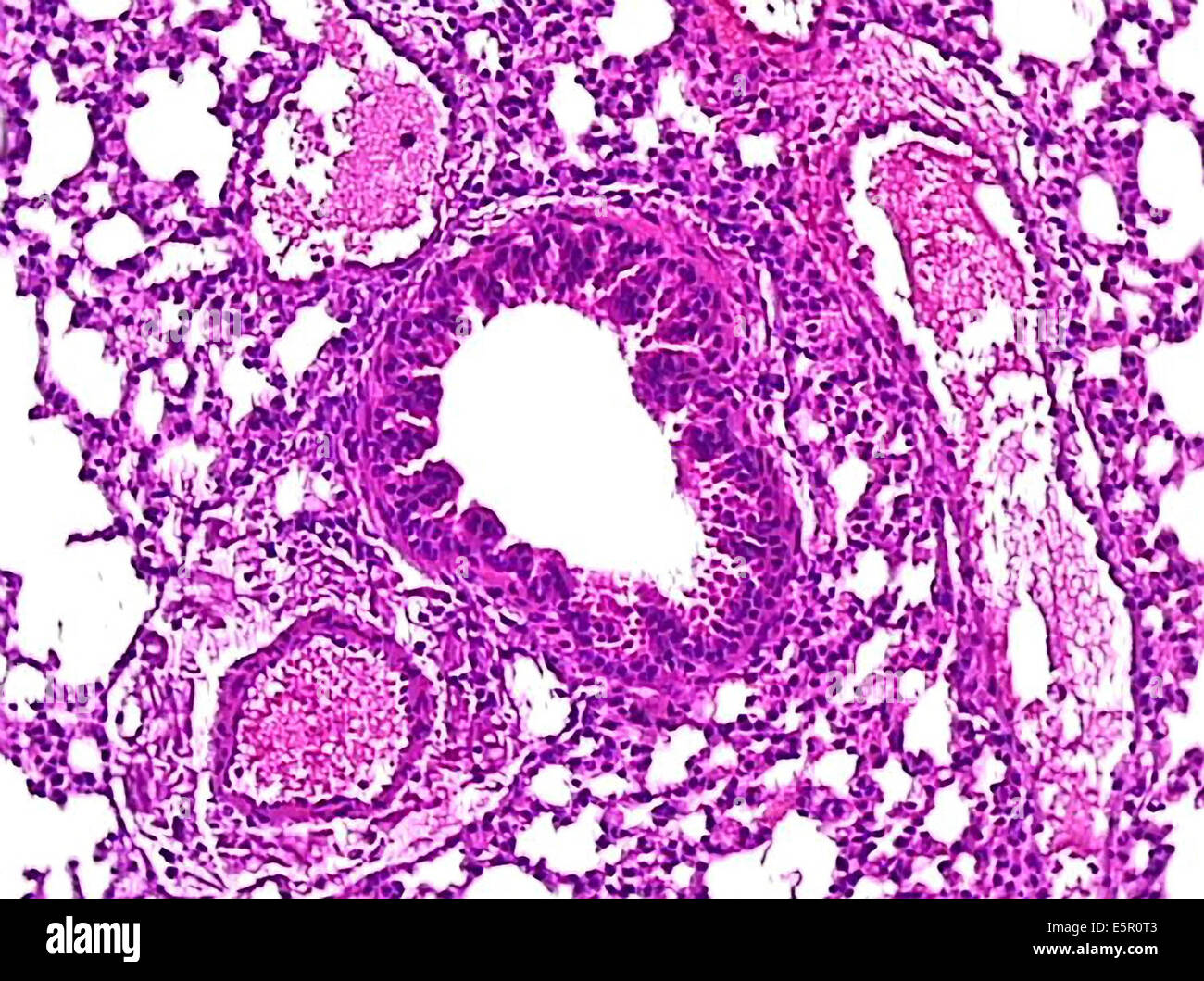 Photomicrograph of lung tissus showing a section of brunchus at center with surrounding blood vessels. Stock Photo