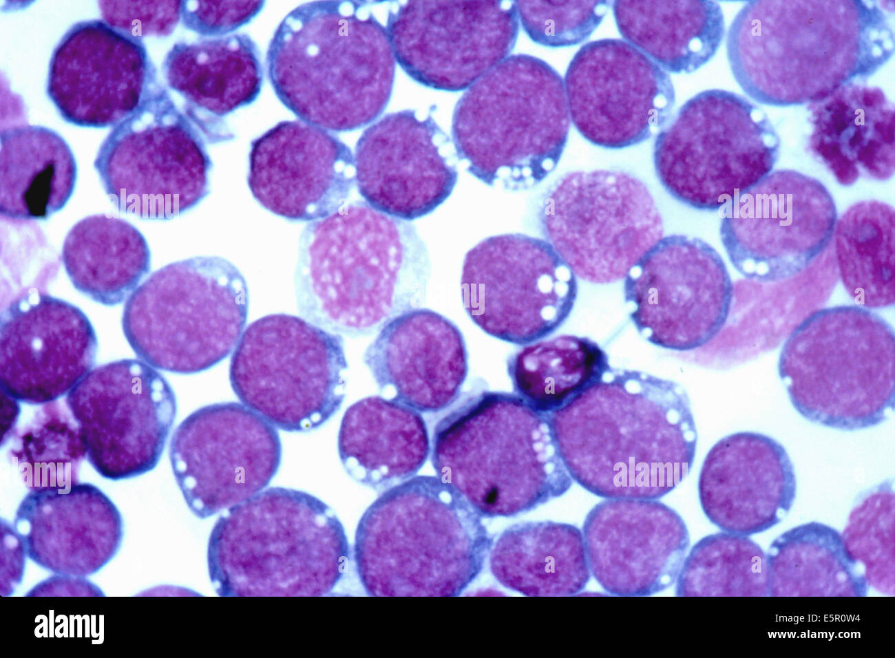 Photomicrograph of blood cells infected by the Epstein-Barr virus (EBV), an Herpesvirus responsible for infectious Stock Photo