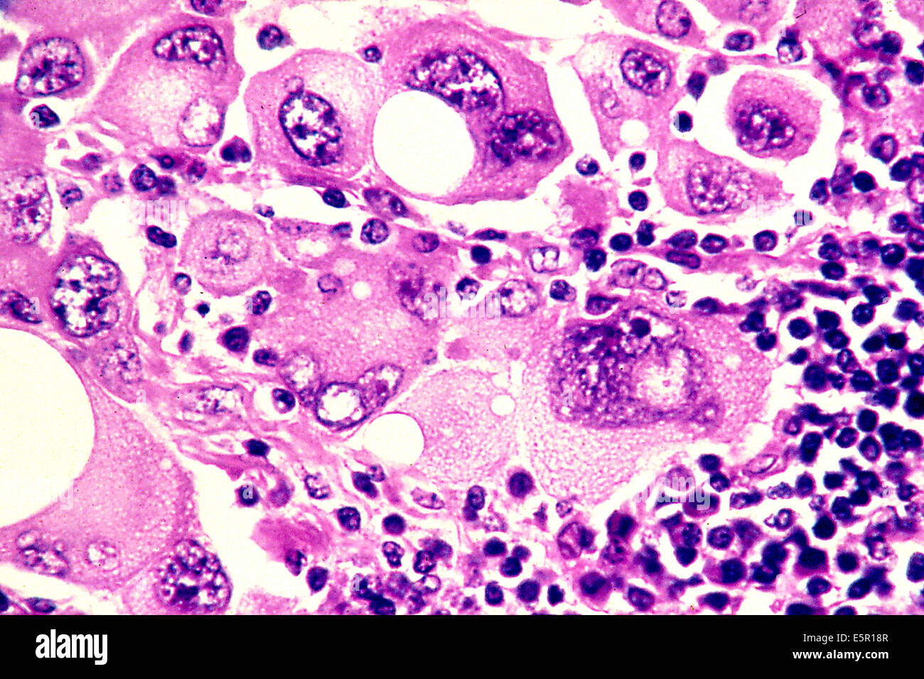 Photomicrograph Of Human Metastatic Melanoma Cells Magnified To 320x