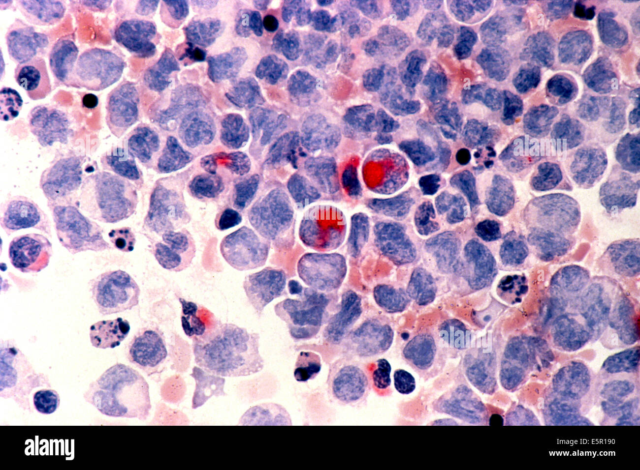 Photomicrograph of human white blood cells with acute myelocytic leukemia ( AML ) in the pericardial fluid, shown with an Stock Photo
