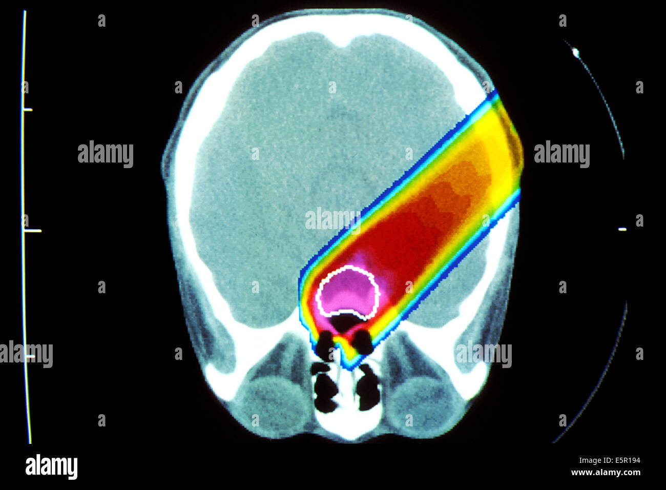 Image of a proton beam irradiating a brain tumor (circled in white). Stock Photo
