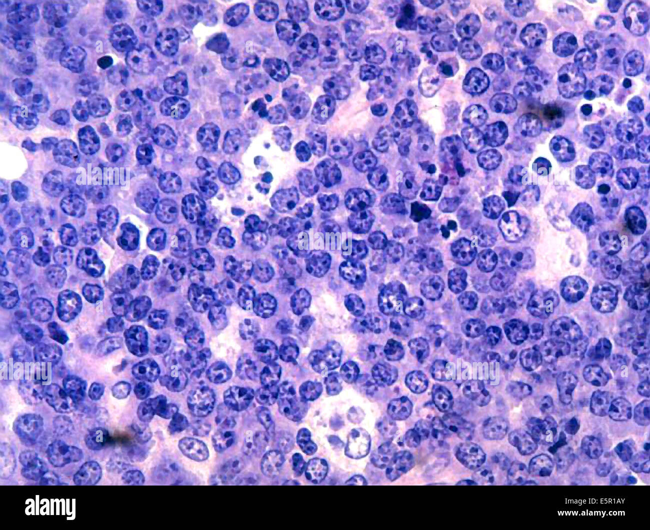 Photomicrograph of malignant B-cell lymphocytes seen in Burkitt's lymphoma, The Epstein-Barr virus has been isolated from Stock Photo