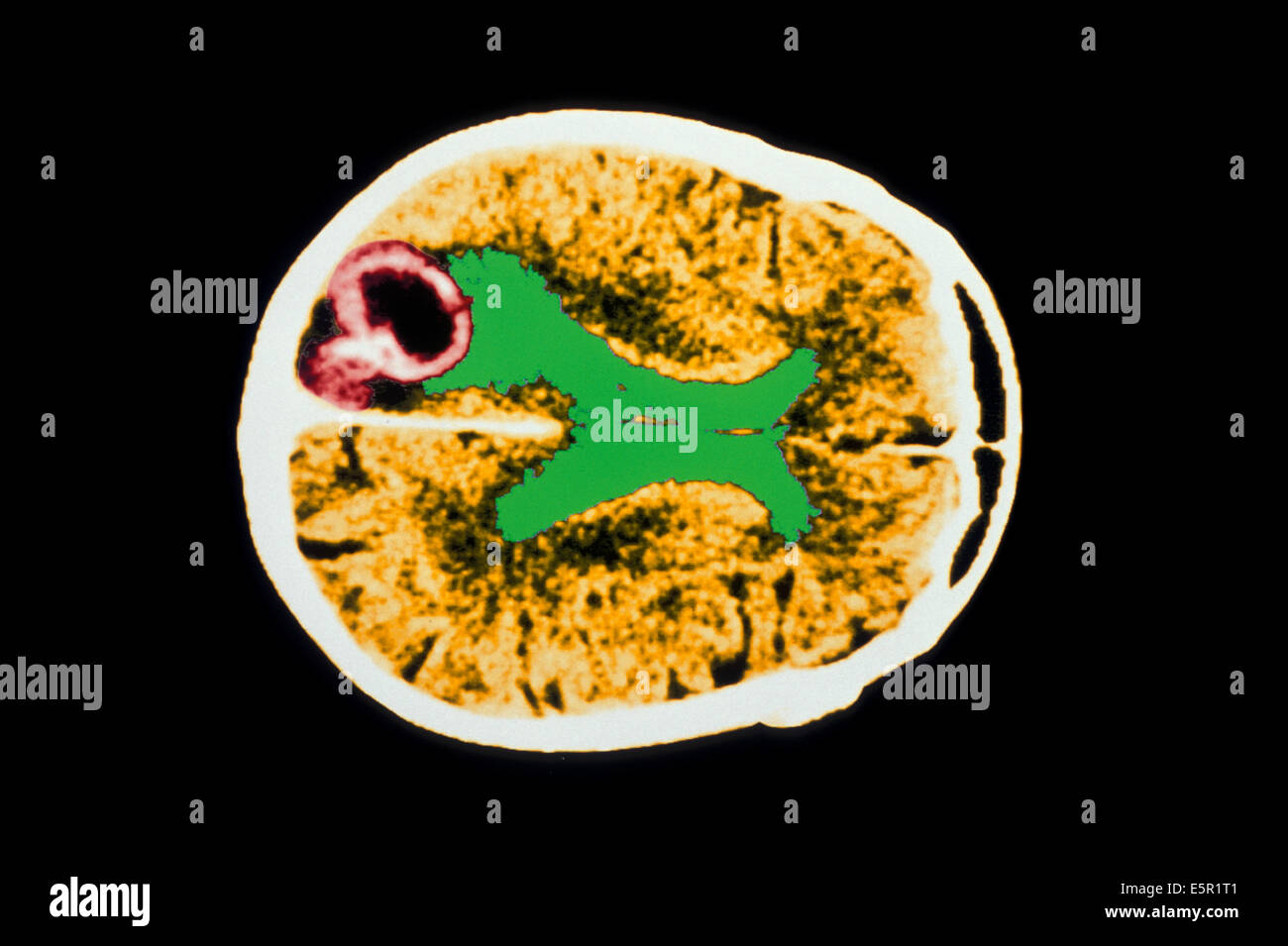 Axial computed Tomography (CT) scan of a child's brain showing encephalitis in the left temporal, caused by an infection with Stock Photo
