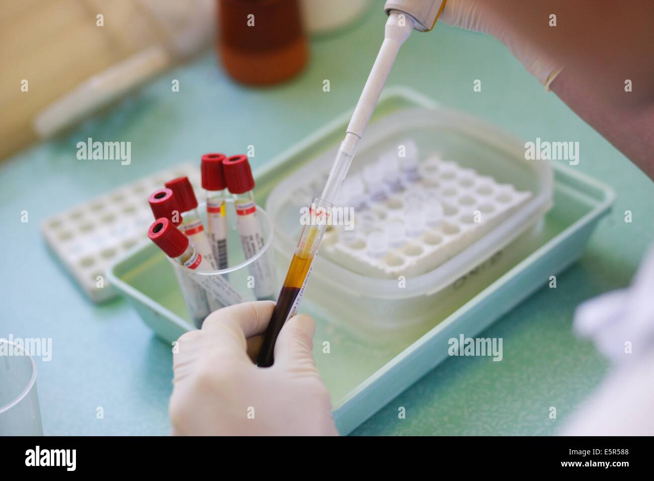 Researcher is pipetting blood serum from obese person in eppendorf
