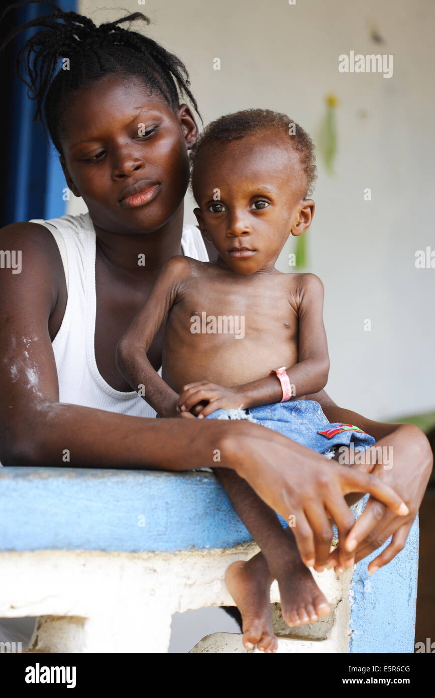 Marasmus hi-res stock photography and images - Alamy
