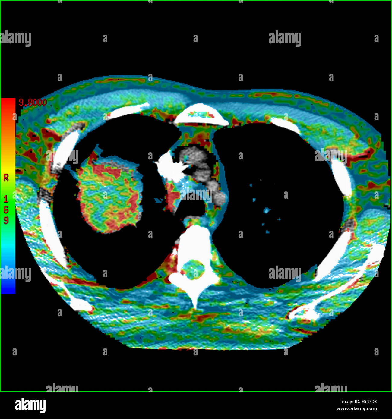 Colored Computed Tomography (CT) scan of the abdomen showing a lung cancer, The red parts of the tumor are the vascularized Stock Photo
