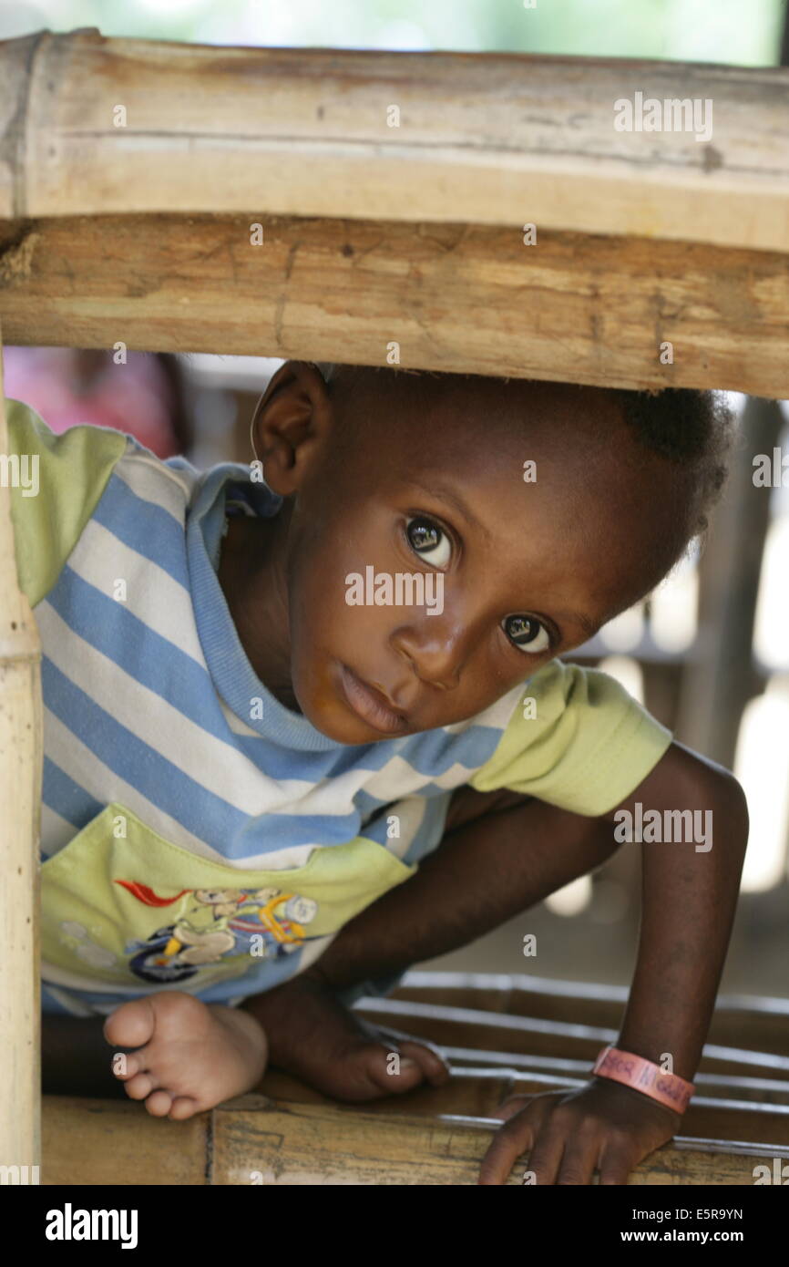 18 months old undernourished child suffering from marasmus in a therapeutic feeding center in Monrovia, Liberia, implemented by Stock Photo