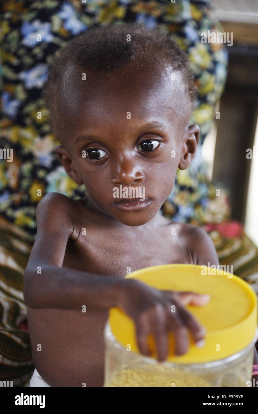 18 months old undernourished child suffering from marasmus in a therapeutic feeding center in Monrovia, Liberia, implemented by Stock Photo