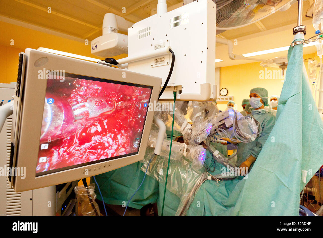Prostatectomy performed by the telesurgery robot Da Vinci, which four articulated arms and camera are controlled at distance by Stock Photo