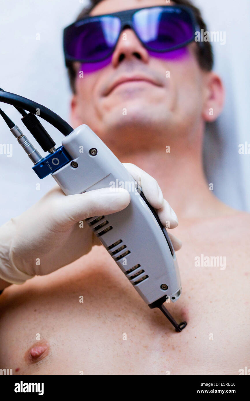 Man undergoing KTP laser treatment, Pulsed dye KTP laser used in treatment of rosacea and