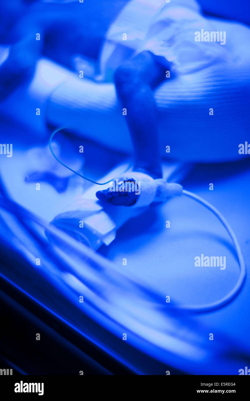 Newborn baby undergoing ultraviolet light treatment for jaundice