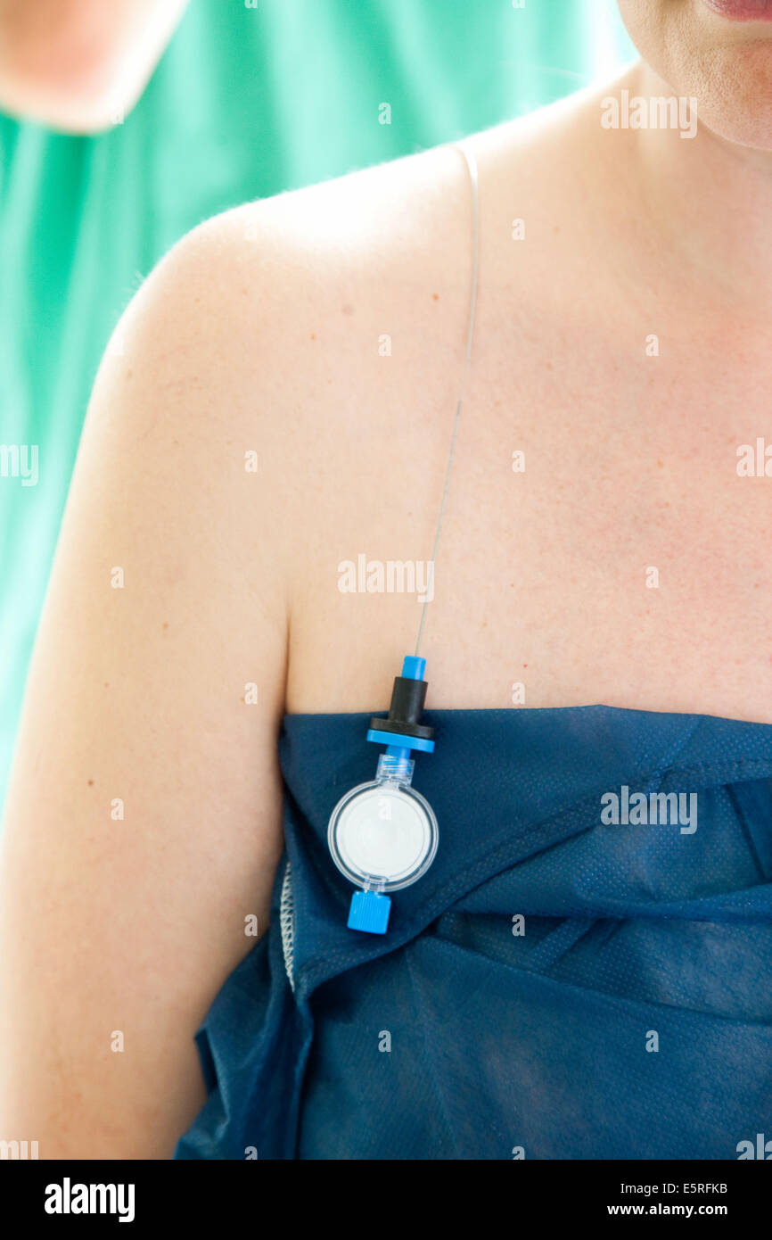 Pregnant woman receiving epidural anaesthesia before delivery, Self