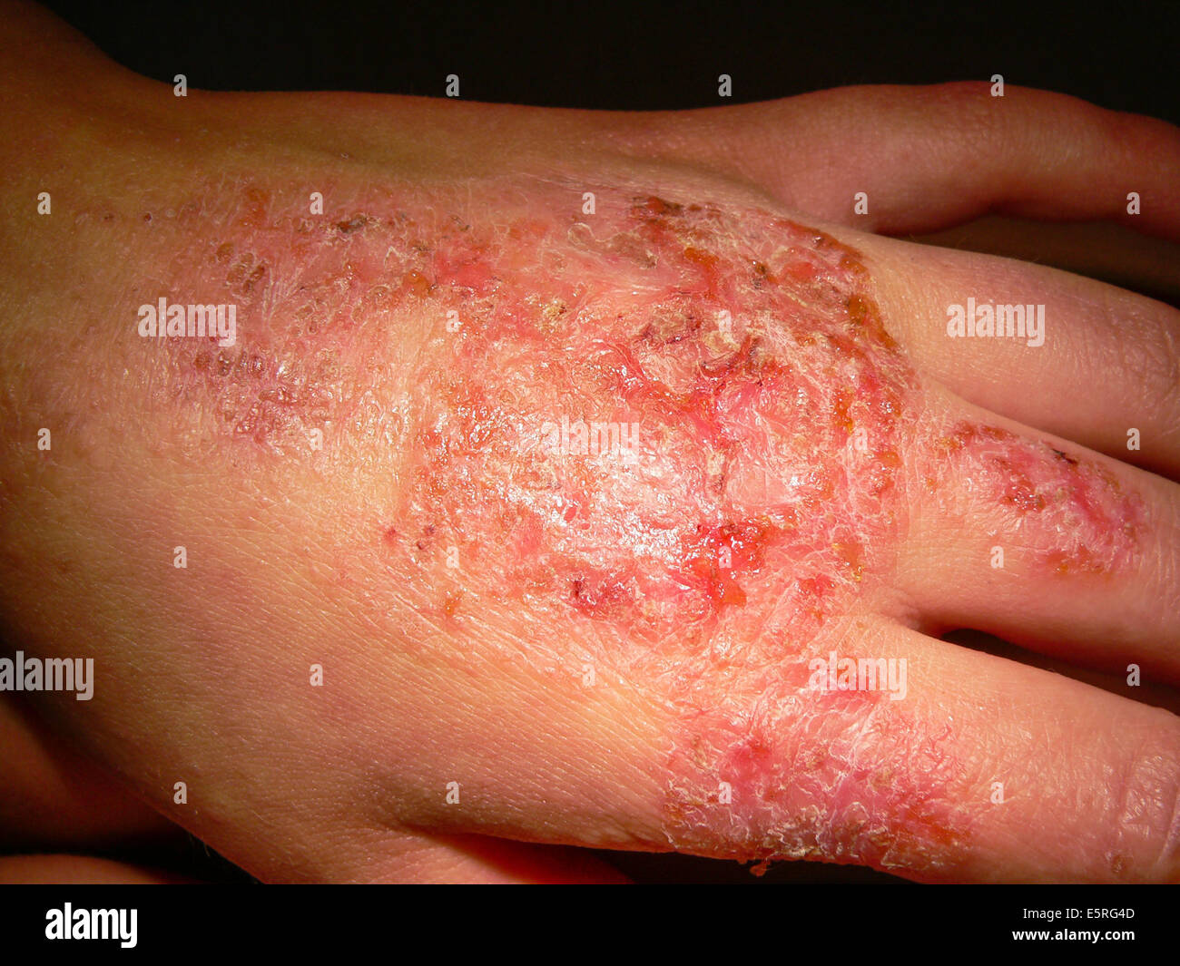 Eczema of the hand. Stock Photo