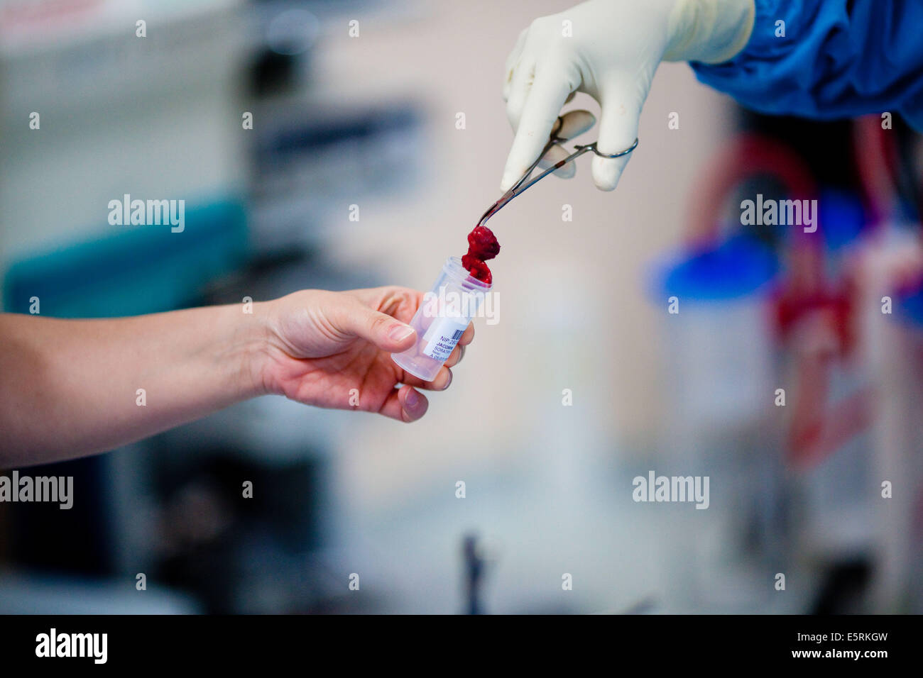 Removal of a lymph node for analysis. Stock Photo