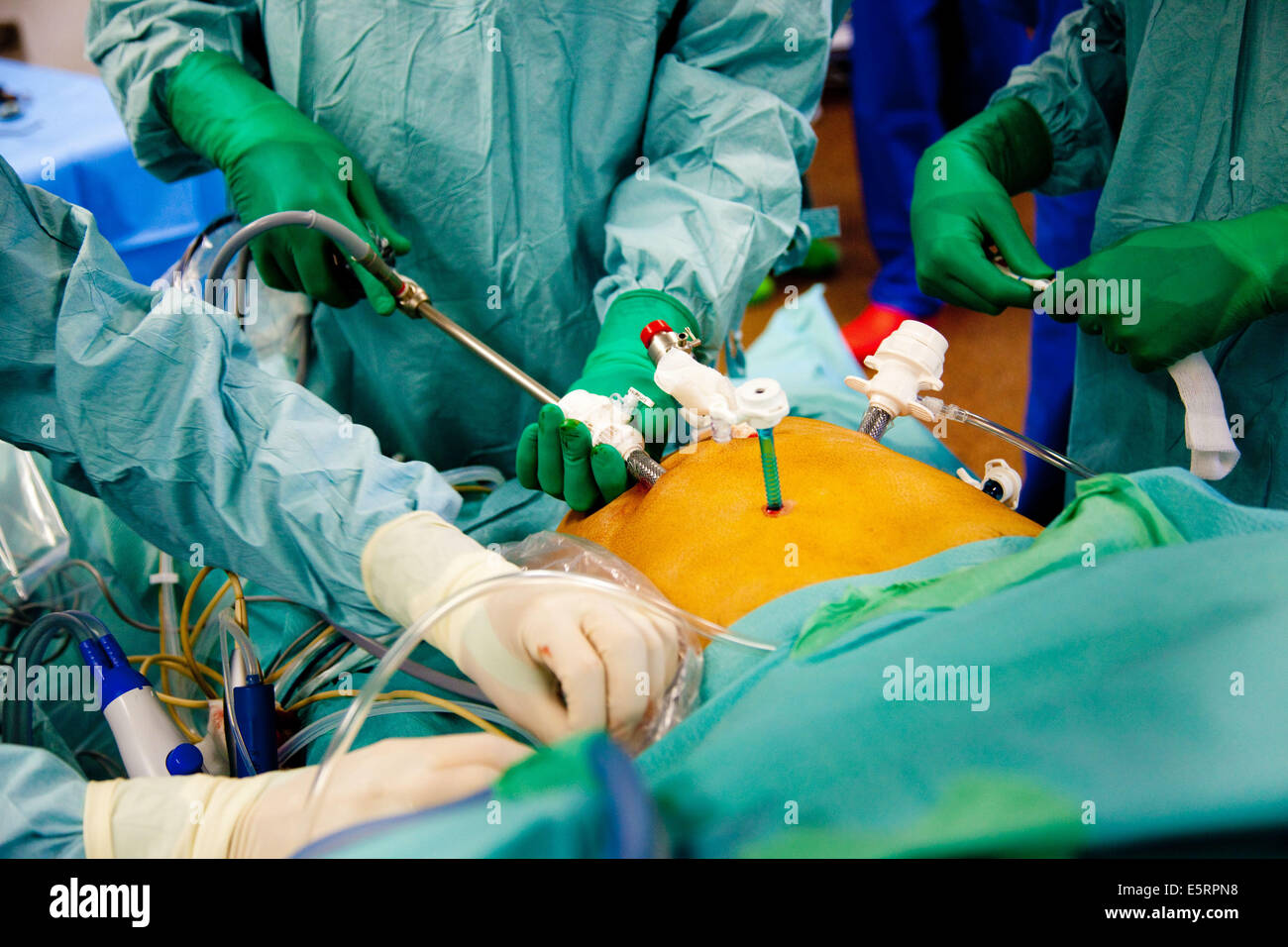 Liver surgery hires stock photography and images Alamy