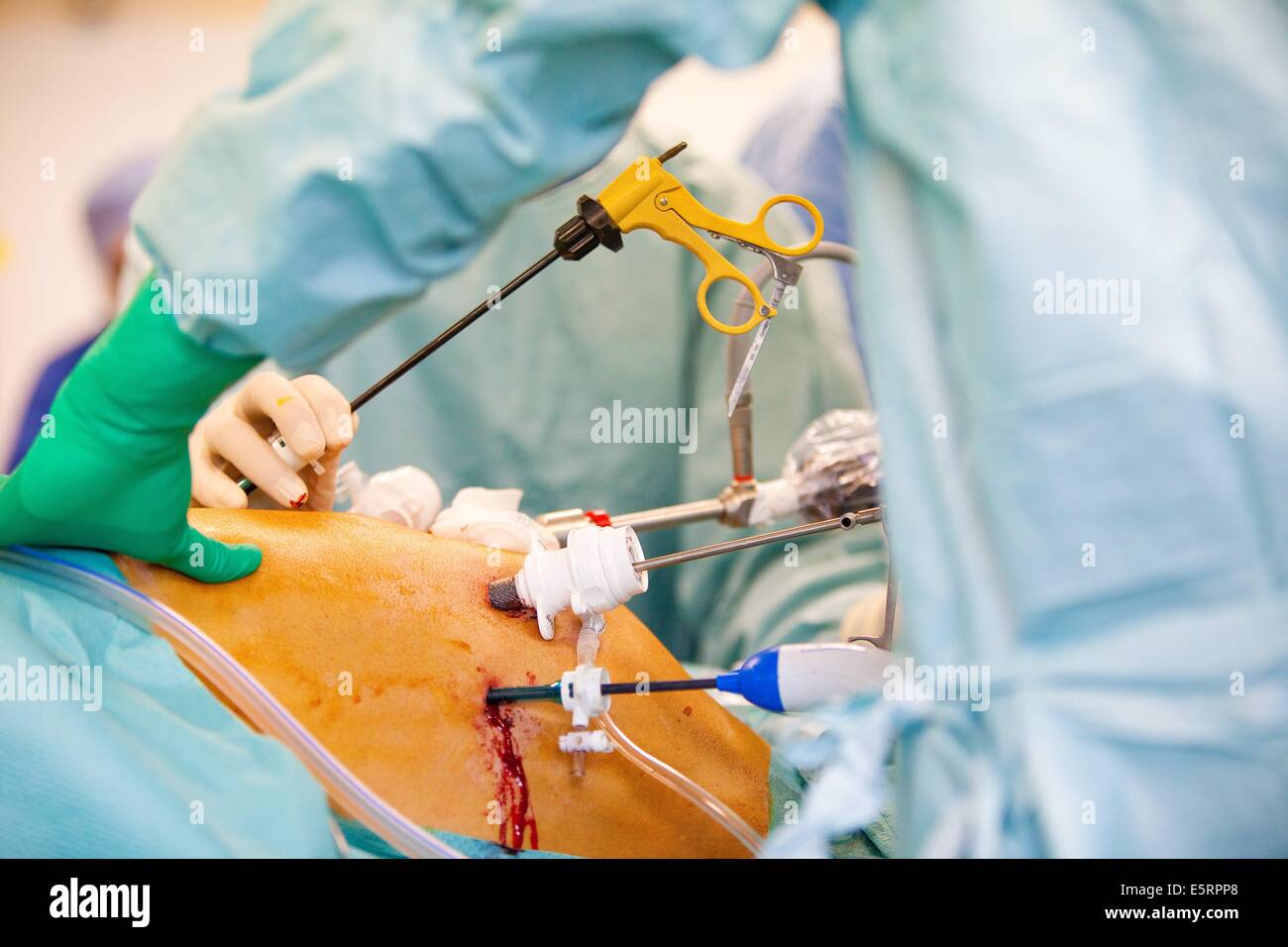 Liver surgery hires stock photography and images Alamy