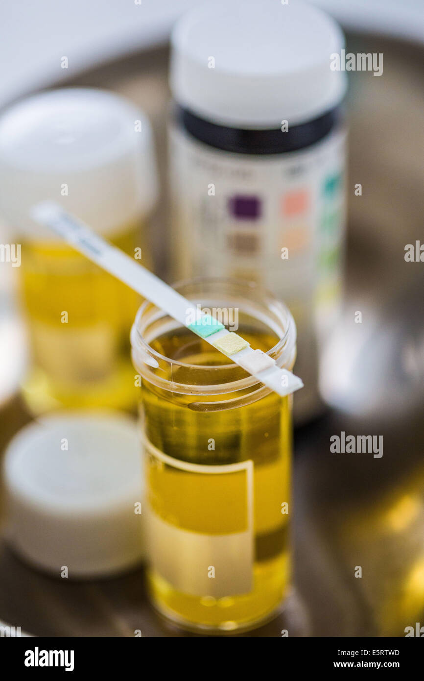 Urine sample with a test strip showing the results. This urine analysis