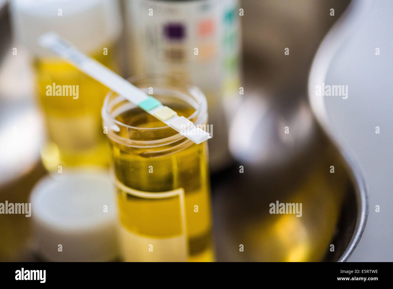 Urine sample with a test strip showing the results. This urine analysis