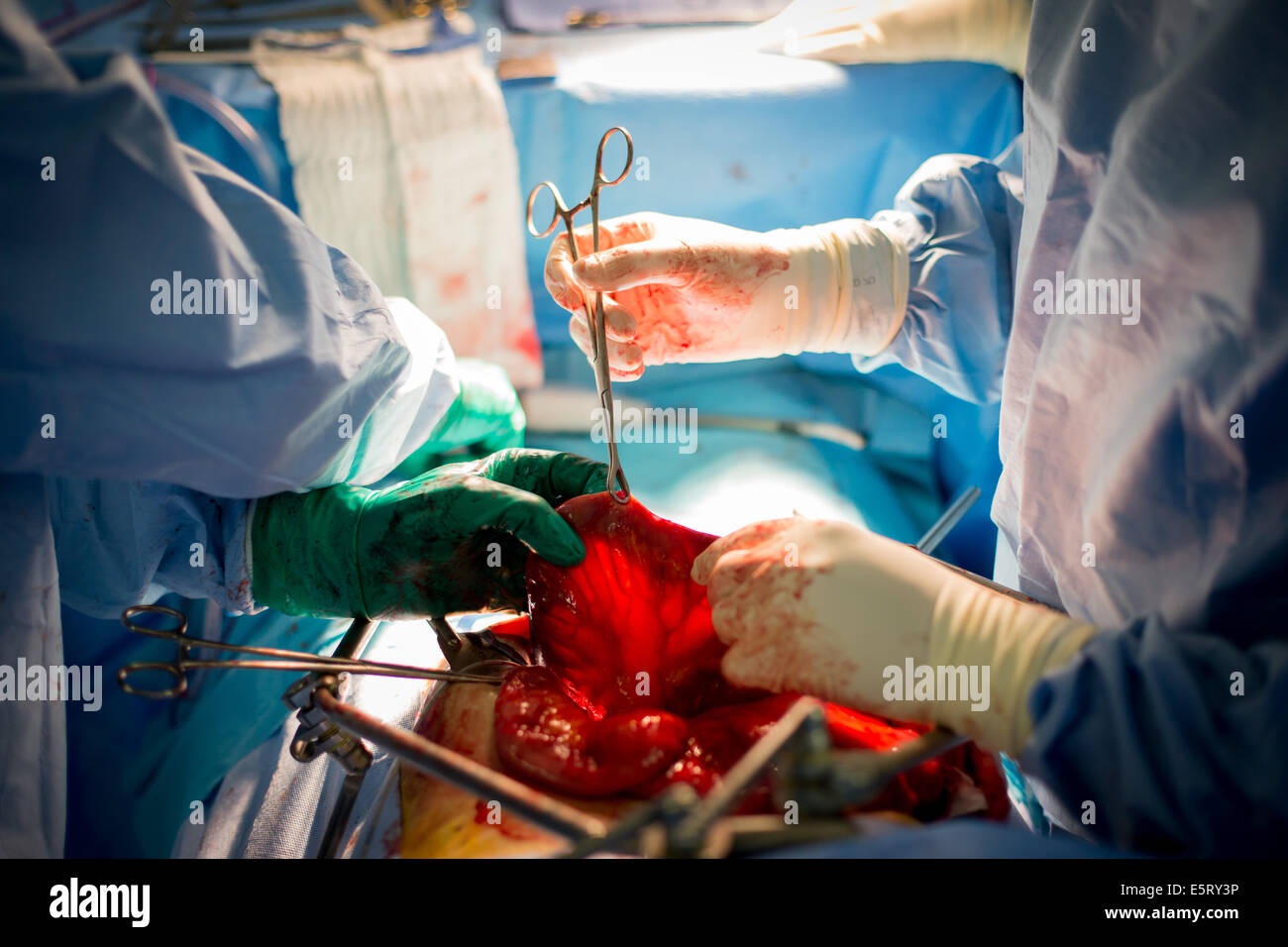 Surgical Treatment Of A Bladder Cancer By Cystectomy Bladder Stock Photo Alamy