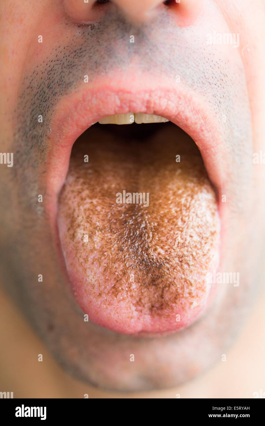 Close-up of black hairy tongue in an adult male patient caused by prolonged use of antibiotic drugs. The filiform papillae on Stock Photo