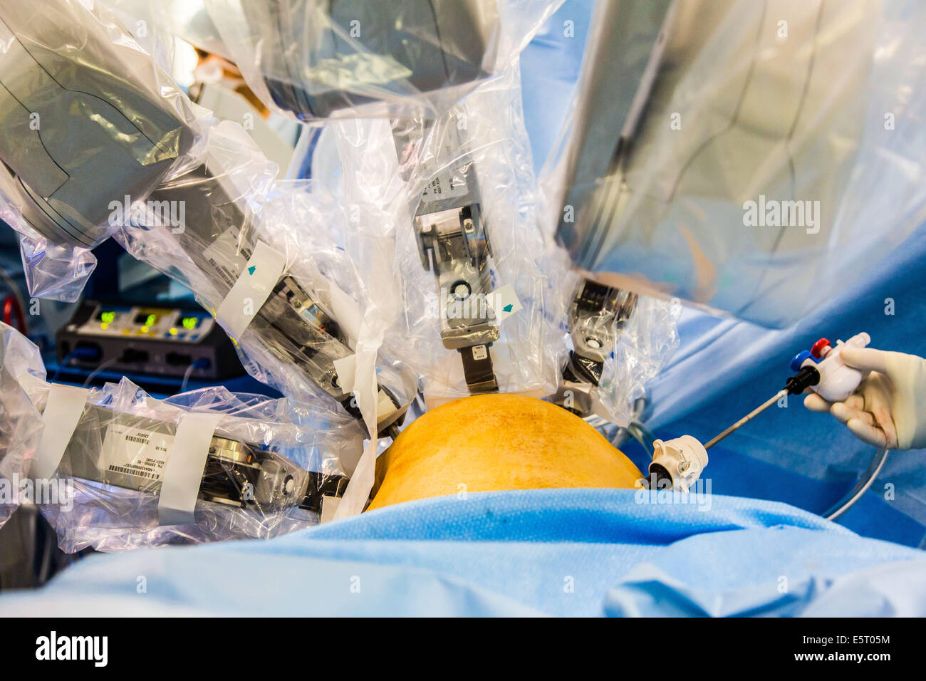 Hysterectomy performed by the telesurgery robot Da Vinci, which four