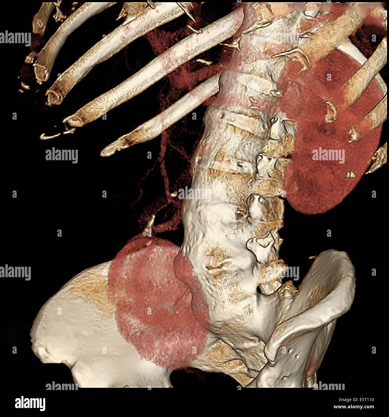 Coloured 3-D computed tomography (CT) scan of an Unilateral Ectopic Kidney in the pelvis. Stock Photo