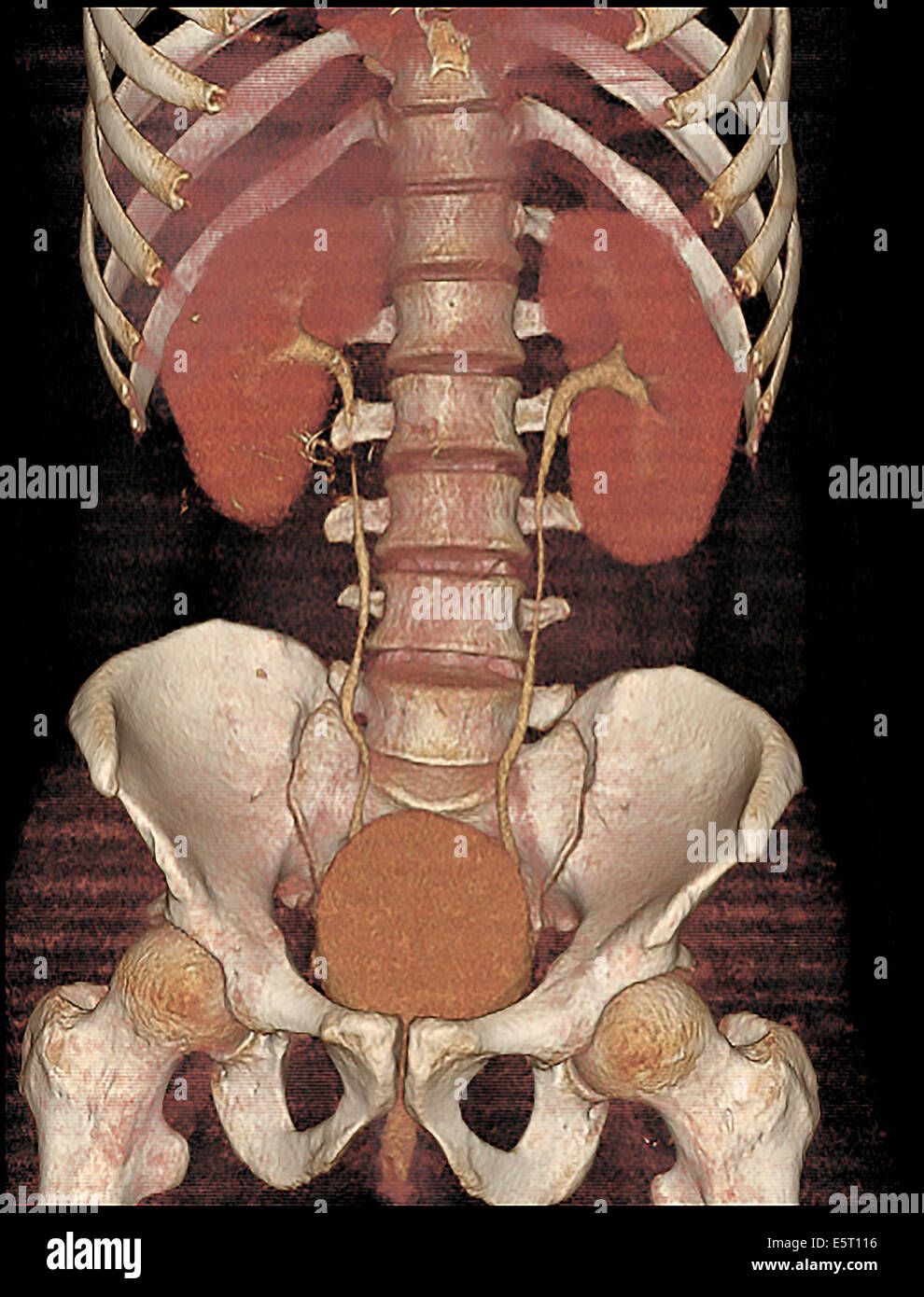 Coloured 3-D computed tomography (CT) scan showing a stenosis of the right ureter. Stock Photo