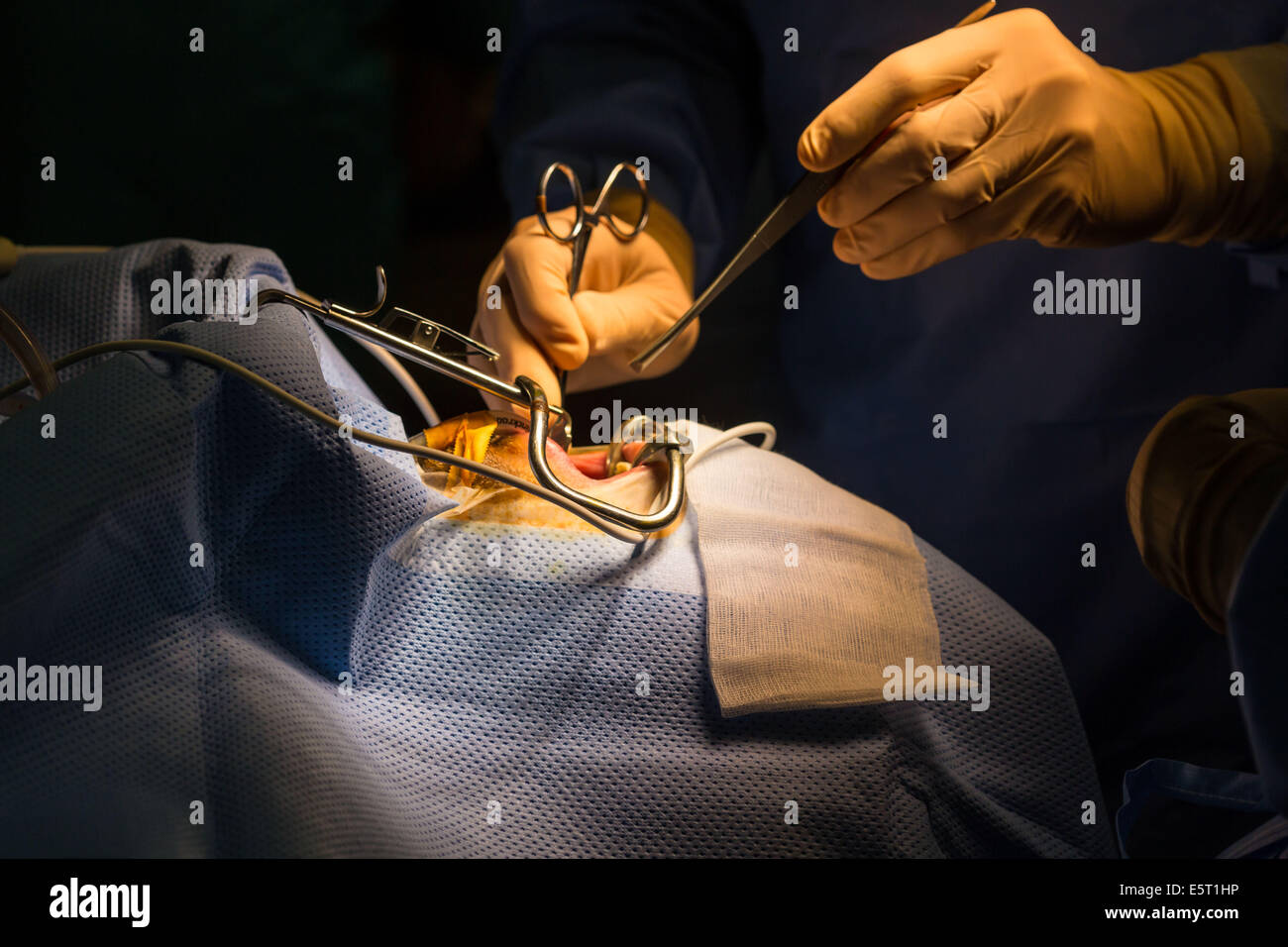 Treatment of snoring tonsillectomy (ablation of tonsils), Foch Hospital