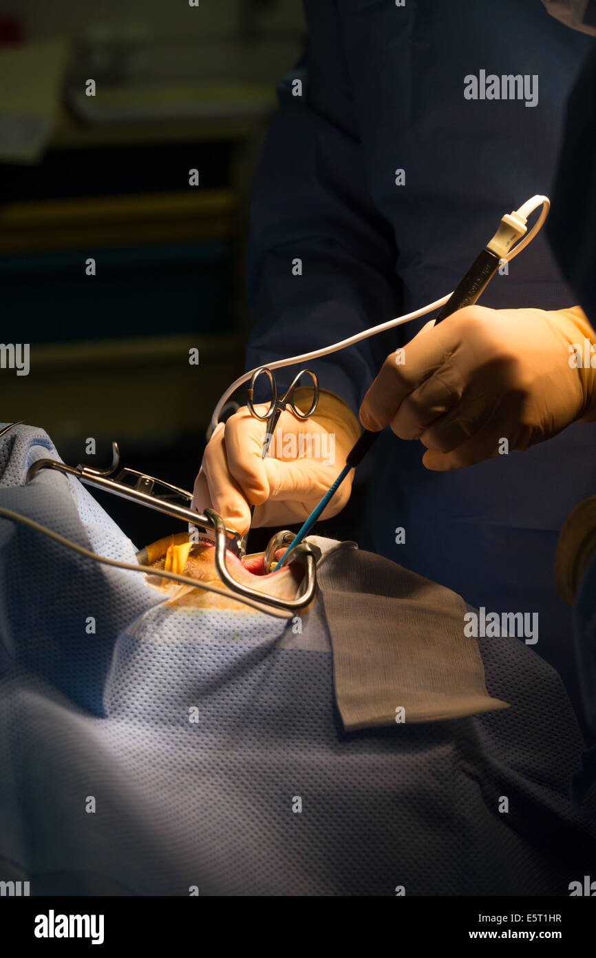 Treatment of snoring tonsillectomy (ablation of tonsils), Foch Hospital