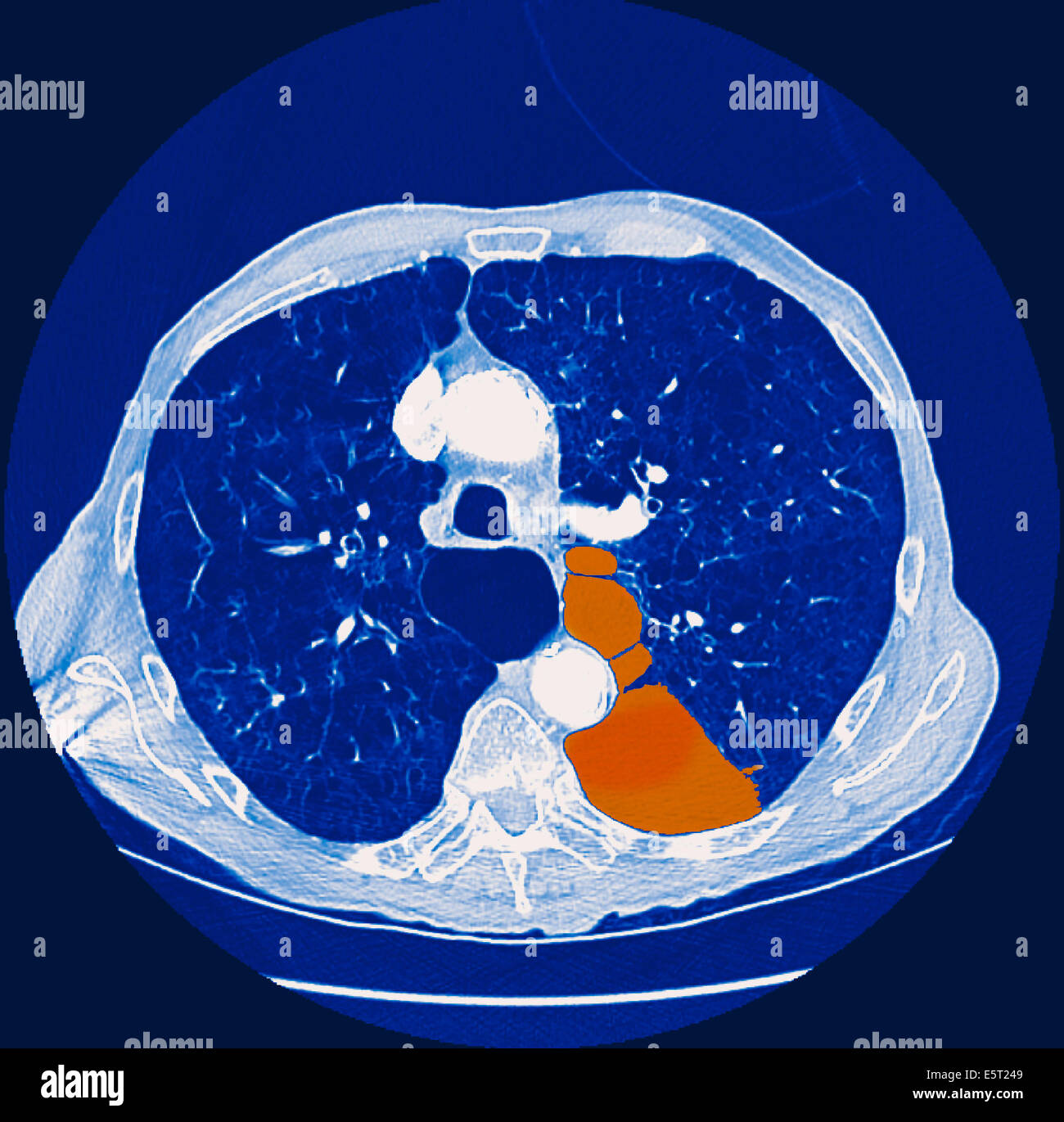 Computed tomography (CT) scan of a section through the chest of a patient with a pneumothorax, or collapsed lung (orange), The Stock Photo
