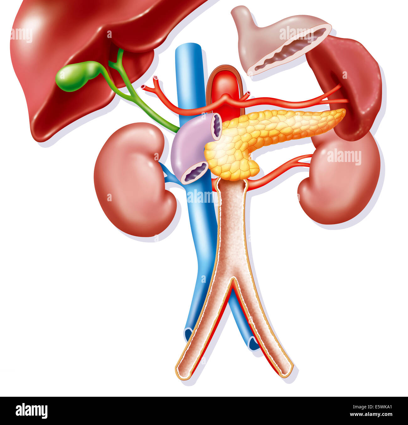 Arterial calcification Stock Photo