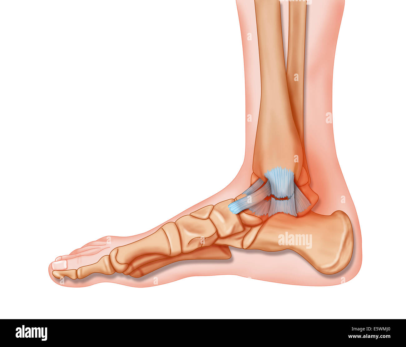 Sprained ankle, drawing Stock Photo - Alamy