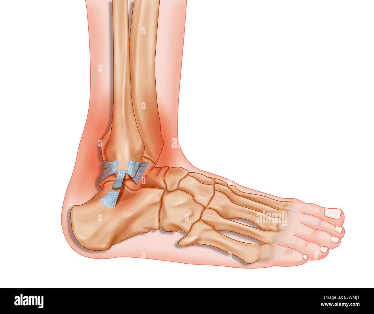 Sprained ankle, drawing Stock Photo - Alamy