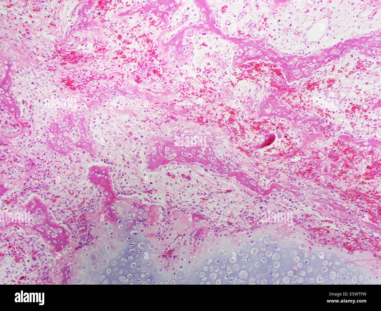 H&E stain, light microscopy, healing fracture callus with exuberant cartilage and new bone formation Stock Photo