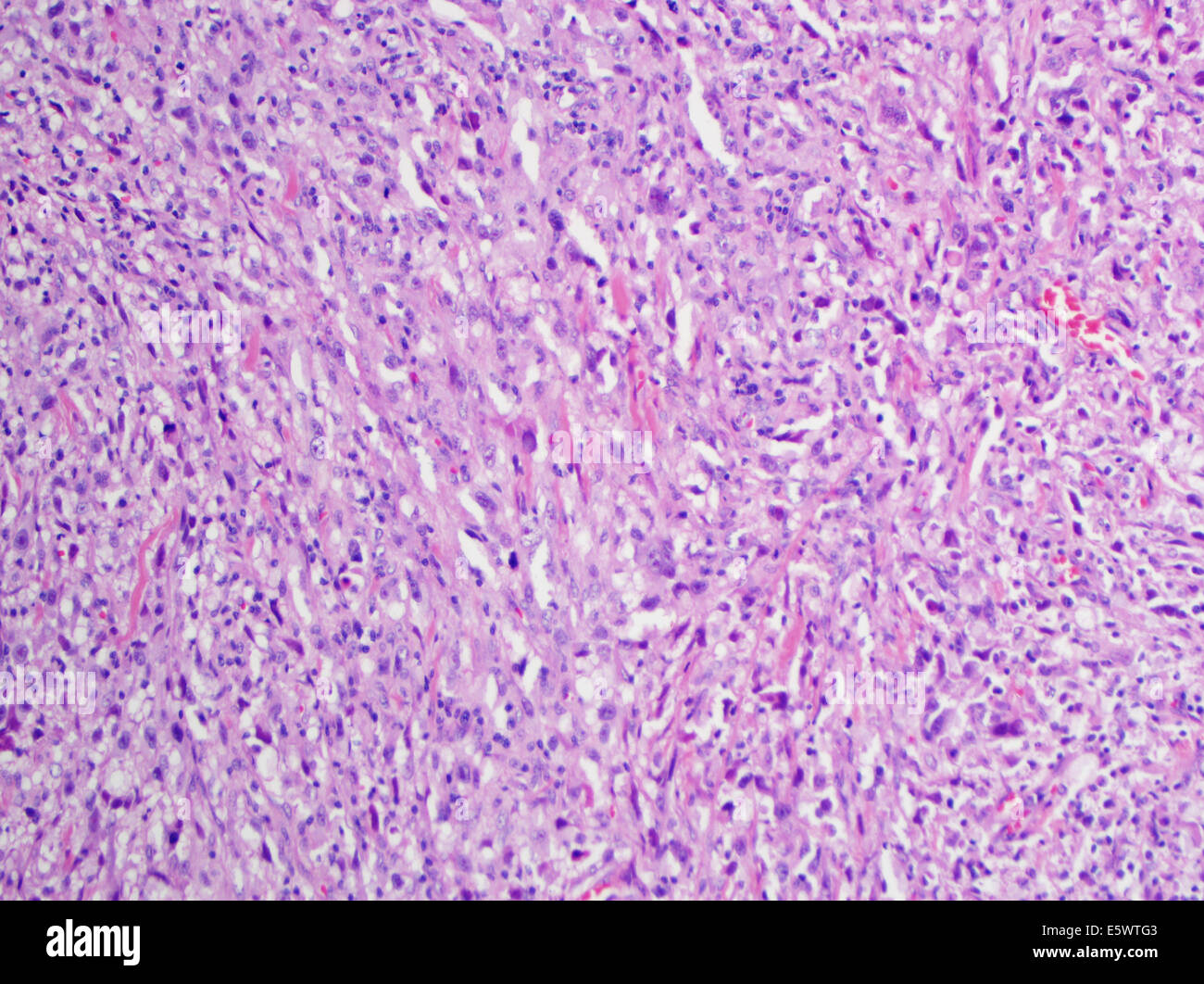 H&E stain, light microscopy, malignant melanoma of skin Stock Photo