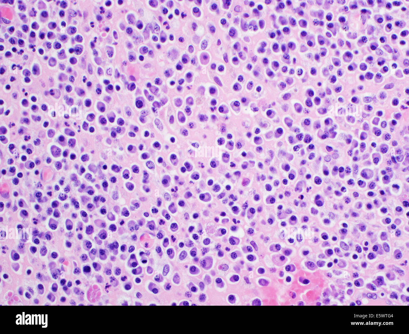 H&E stain, light microscopy, multiple myeloma Stock Photo