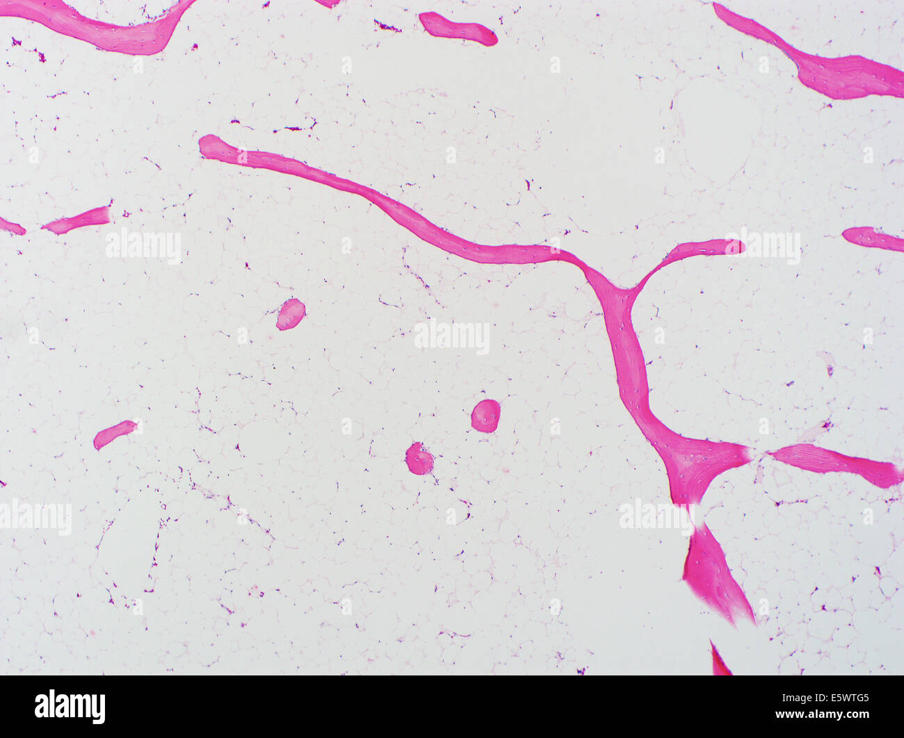 H&E stain, light microscopy, osteoporosis, bone Stock Photo
