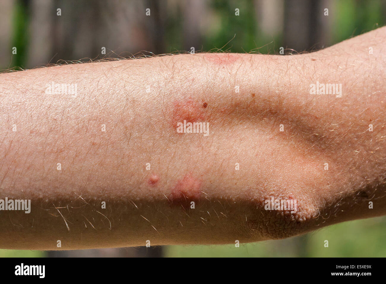 traces of mosquito bites on the human elbow closeup Stock Photo