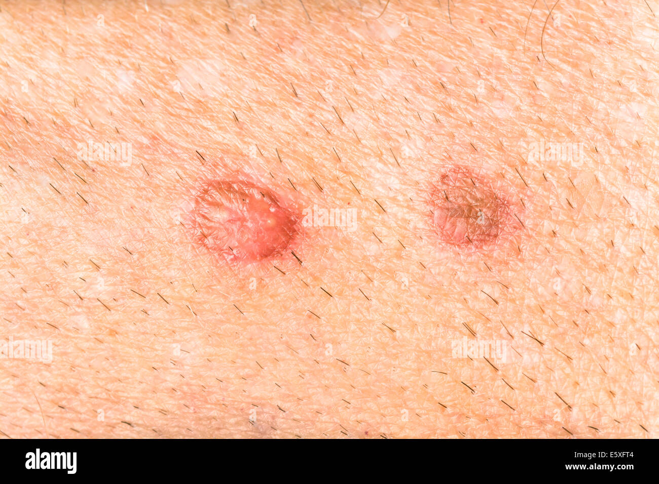 Sores on a human arm show the detail of the healing process by blistering and scabbing Stock Photo