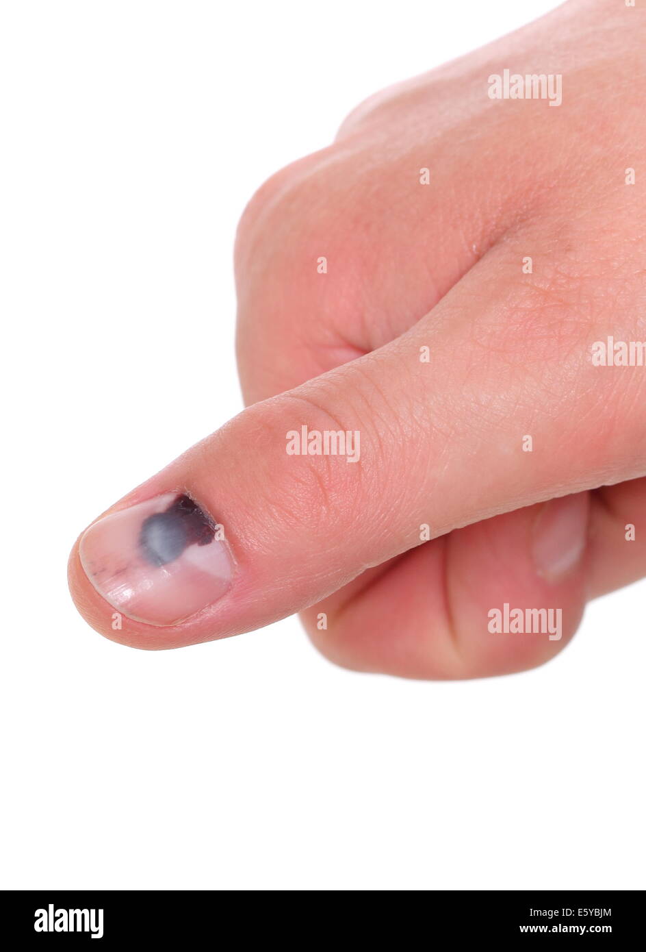 Bruised fingernail hires stock photography and images Alamy