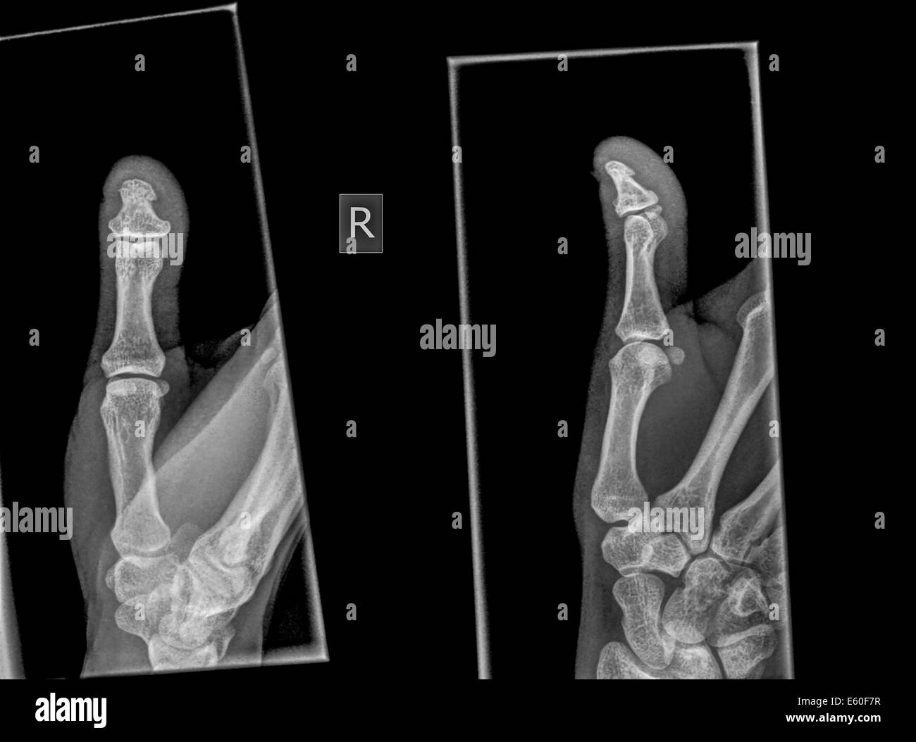 Broken Finger Tip X Ray