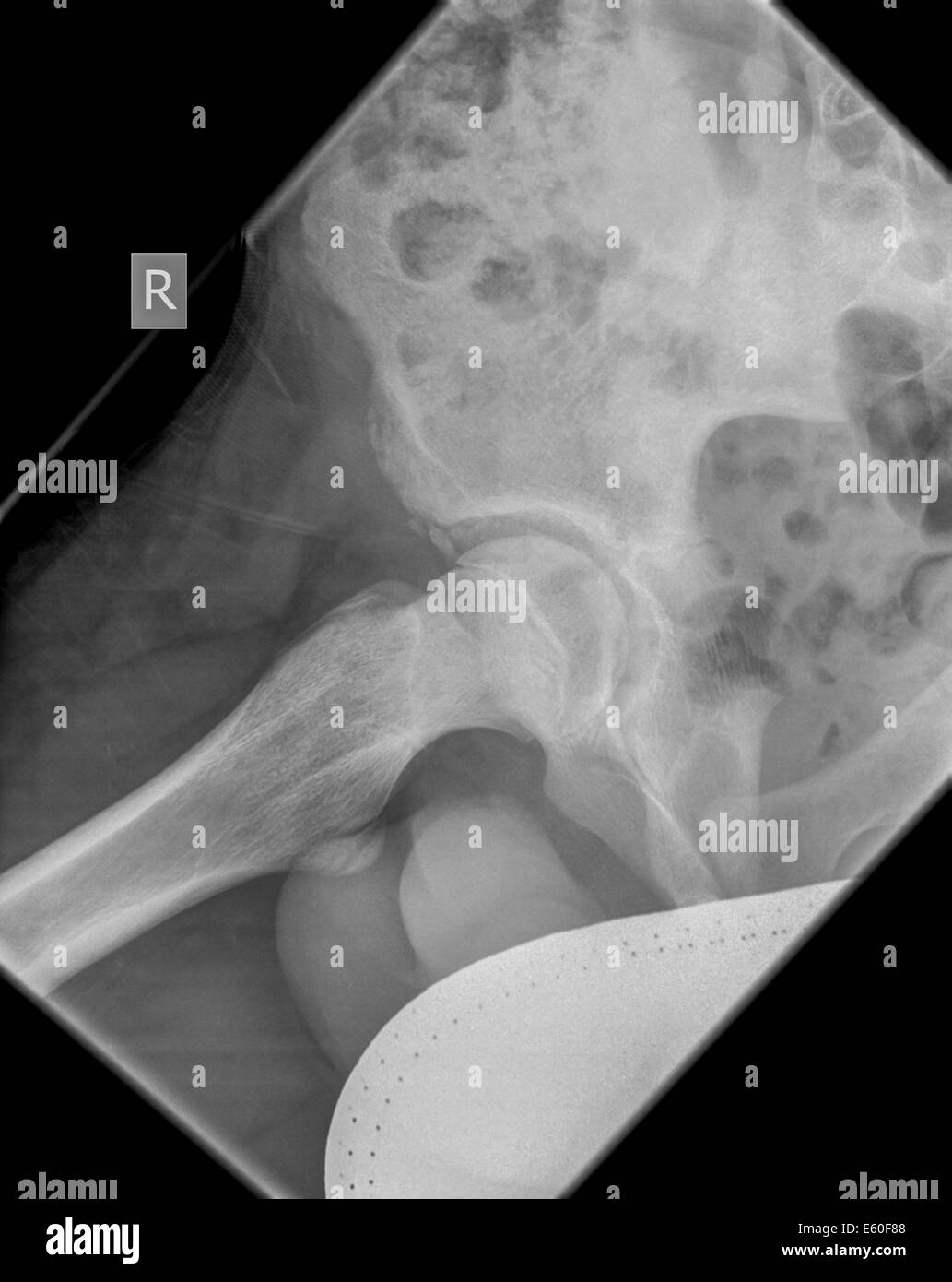Hip x-ray of 13 year old male patient Stock Photo