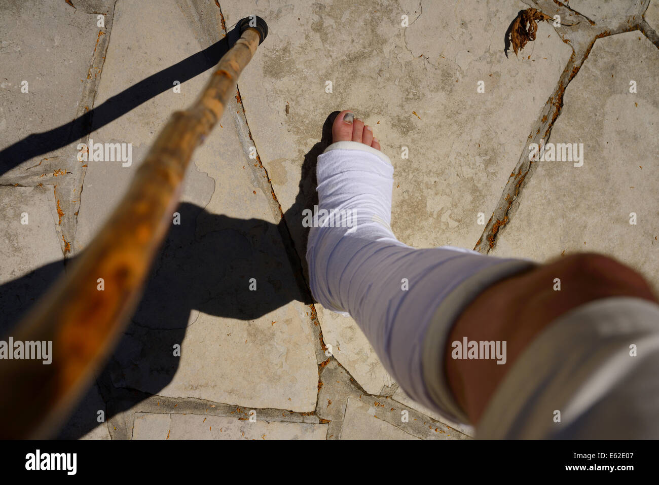 Man with injured leg and cast limping and walking with a cane on stone