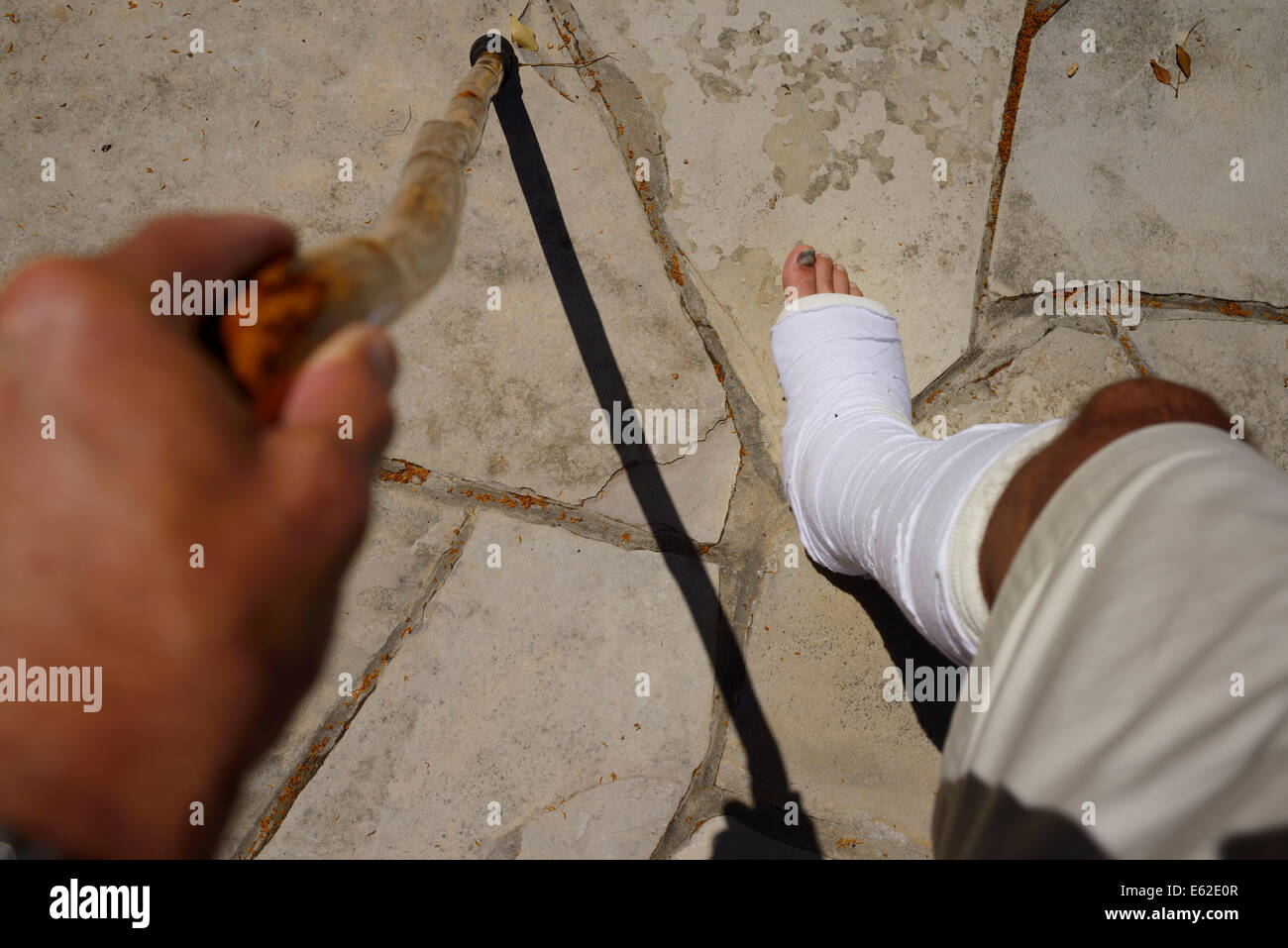 Man with injured leg and cast walking with a cane on a stone walkway in summer Stock Photo