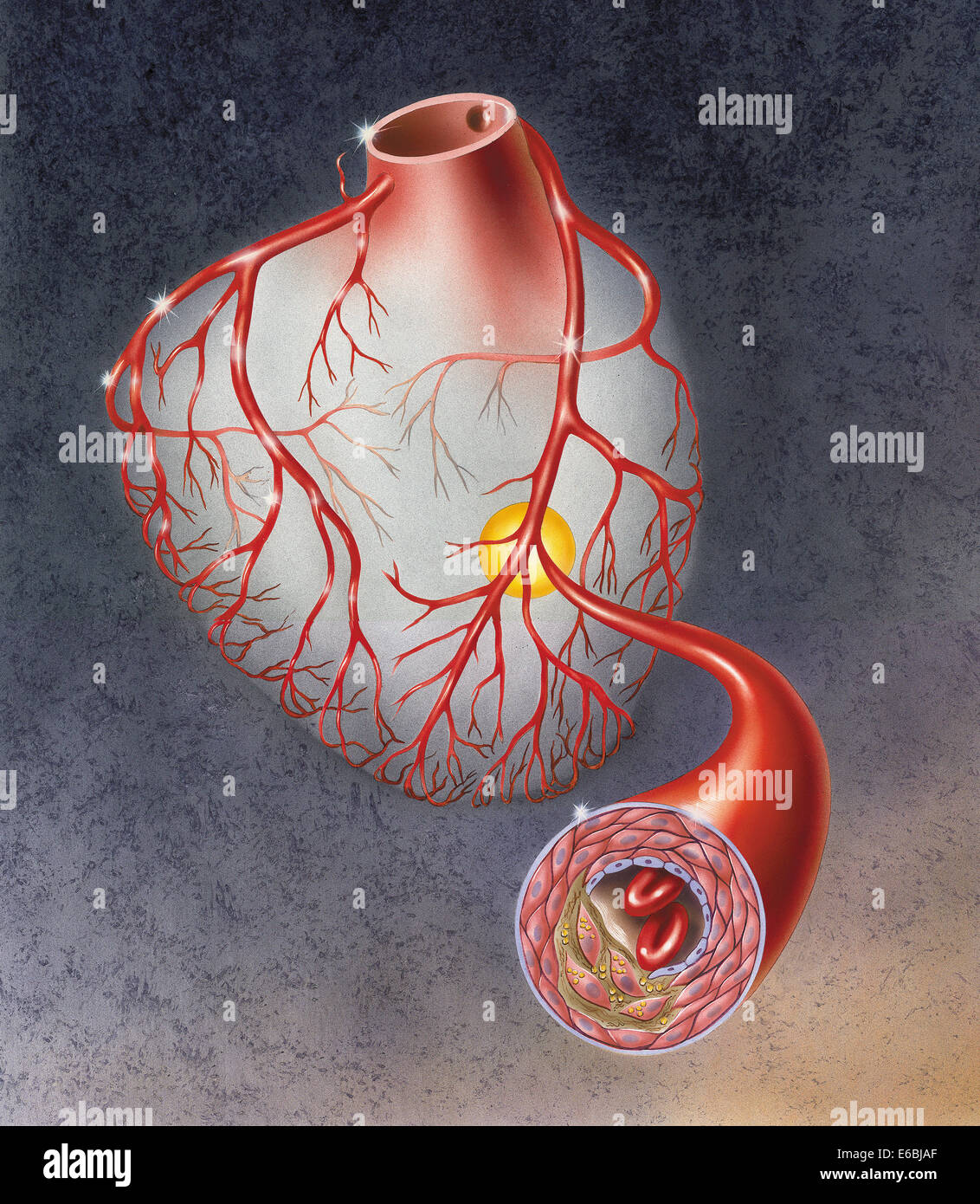 Arteries on heart showing atherosclerotic plaque in an artery. Stock Photo