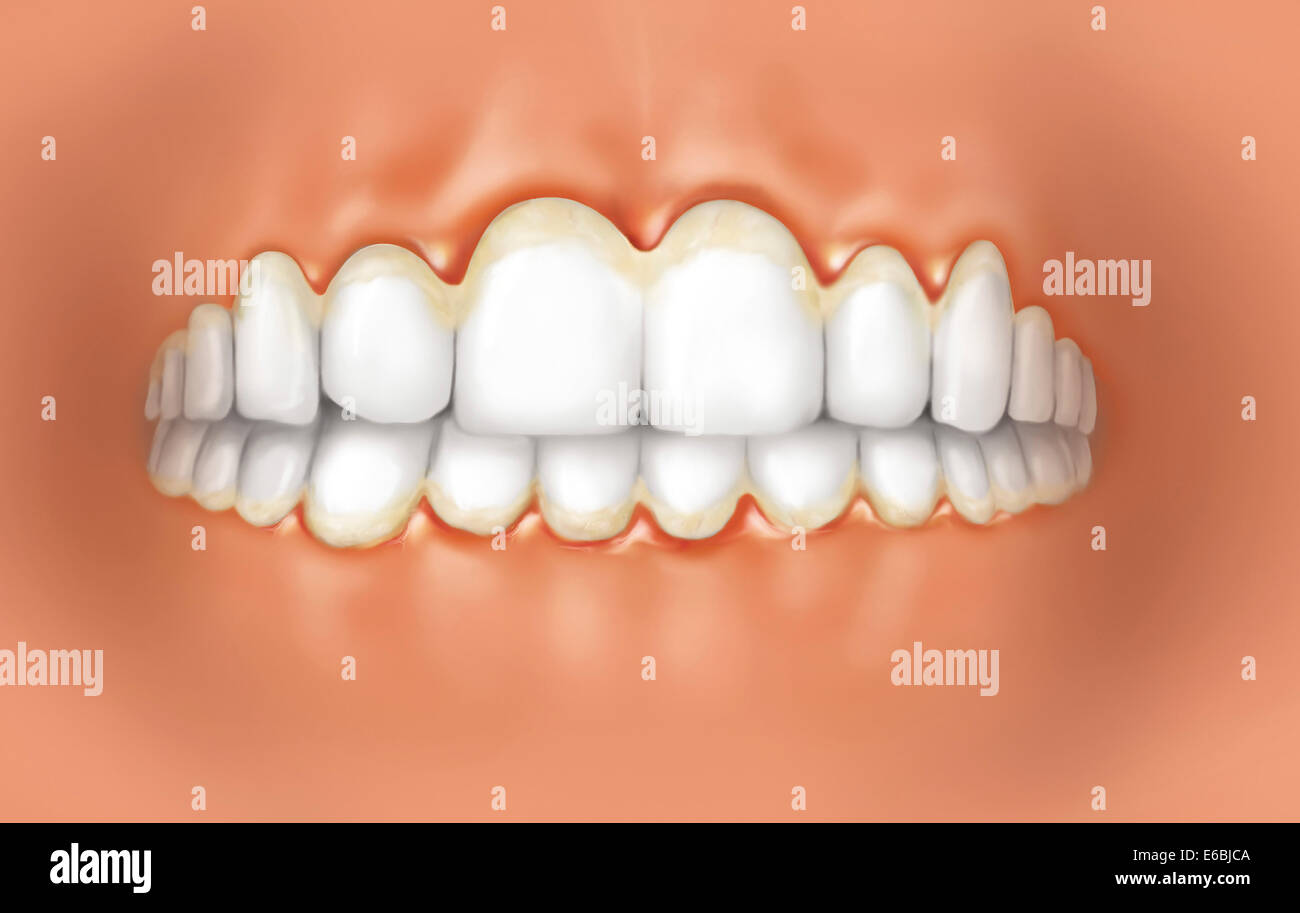 View of teeth showing gingivitis on gums Stock Photo Alamy