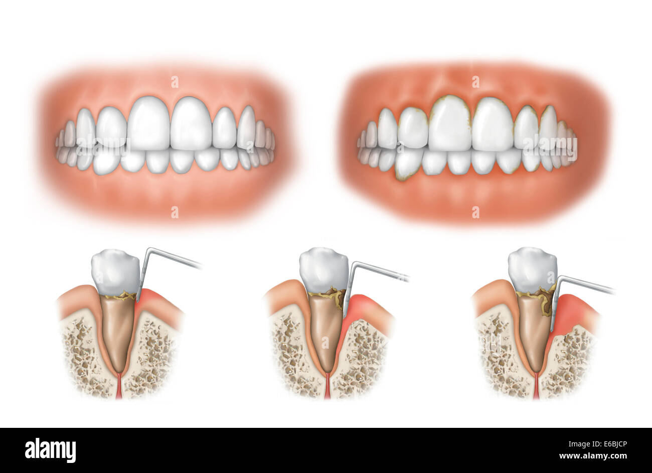 Three stages of periodontal disease. Stock Photo